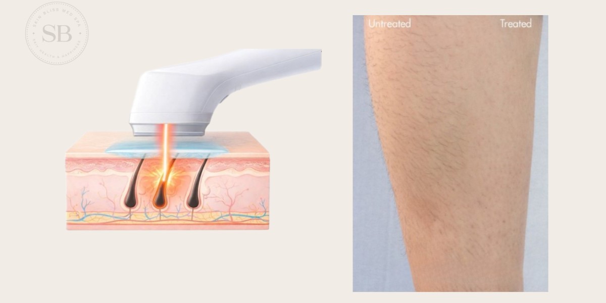 How to Prepare for Laser Hair Removal to Get Better Results and Fewer Sessions