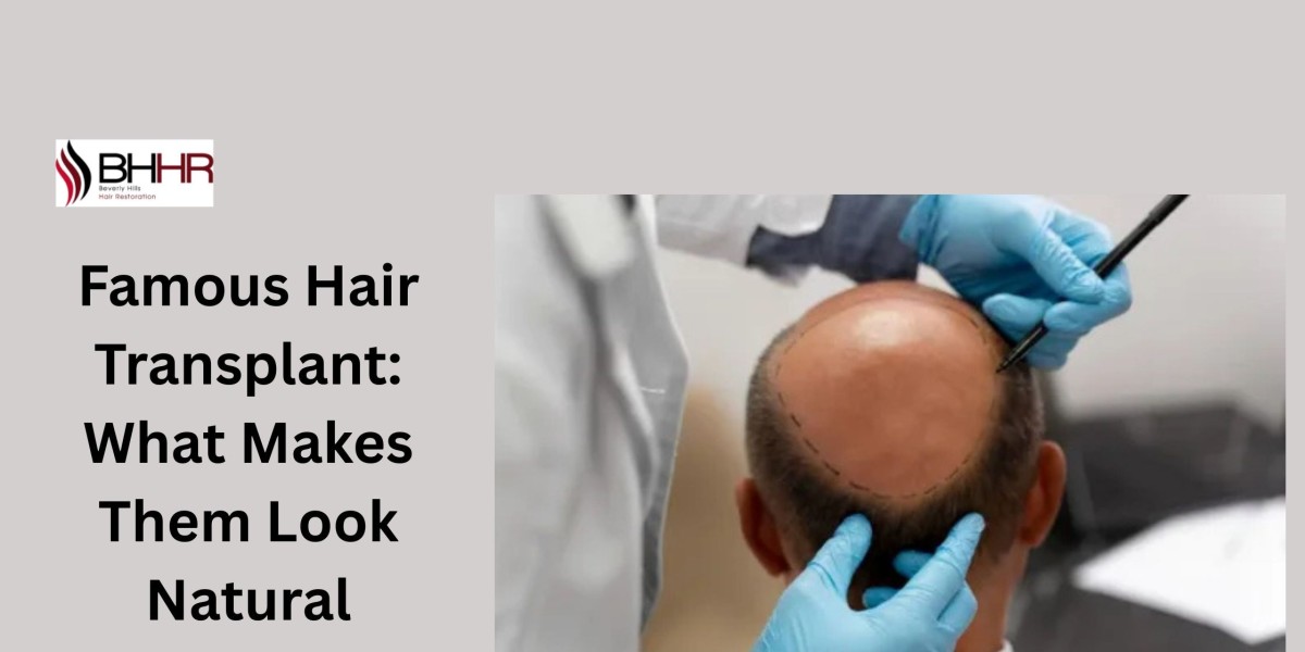 Famous Hair Transplant: What Makes Them Look Natural